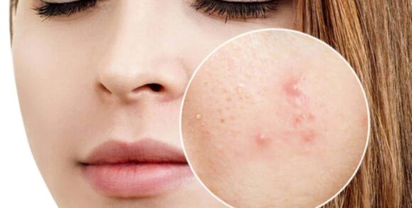 Combata acne e cravos pretos com esta máscara 