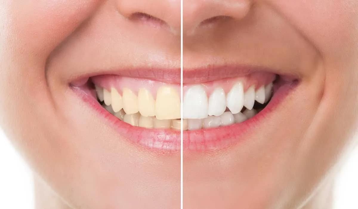 Conheça 8 tipos tratamentos para clarear os dentes