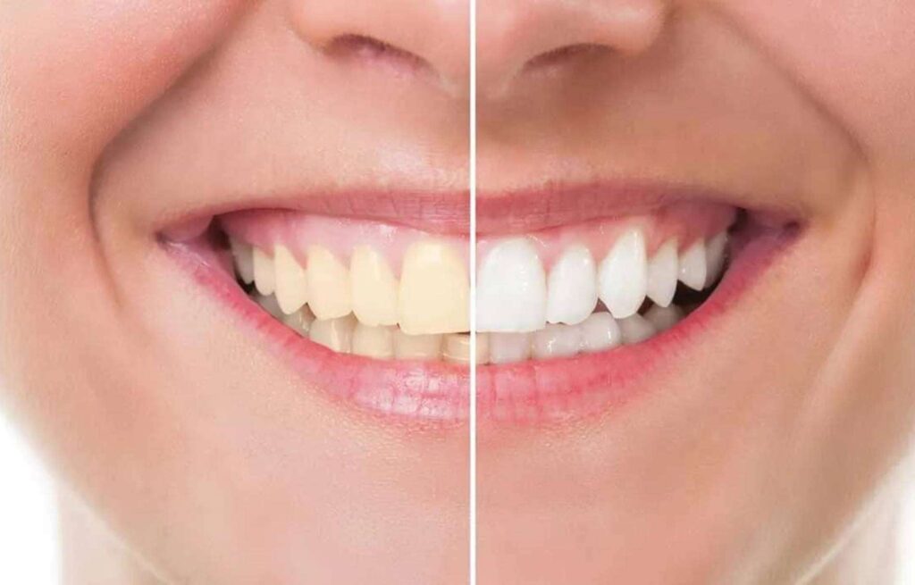 clarear os dentes rapidamente