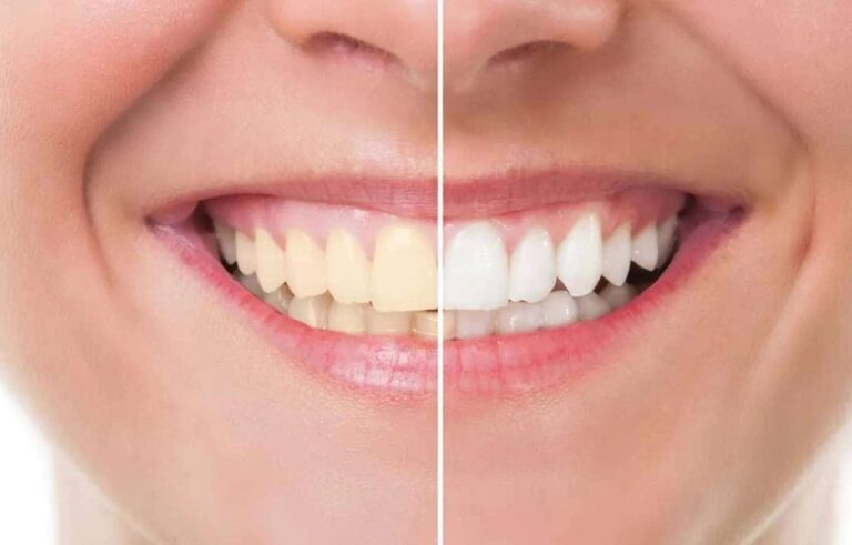 clarear os dentes rapidamente