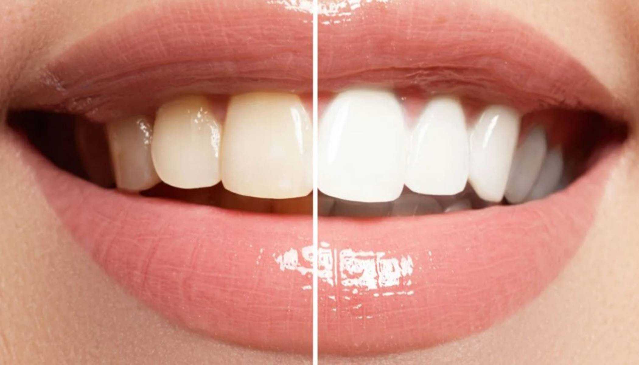 O clareamento dental é um tratamento aplicado em dentes que mudaram de cor