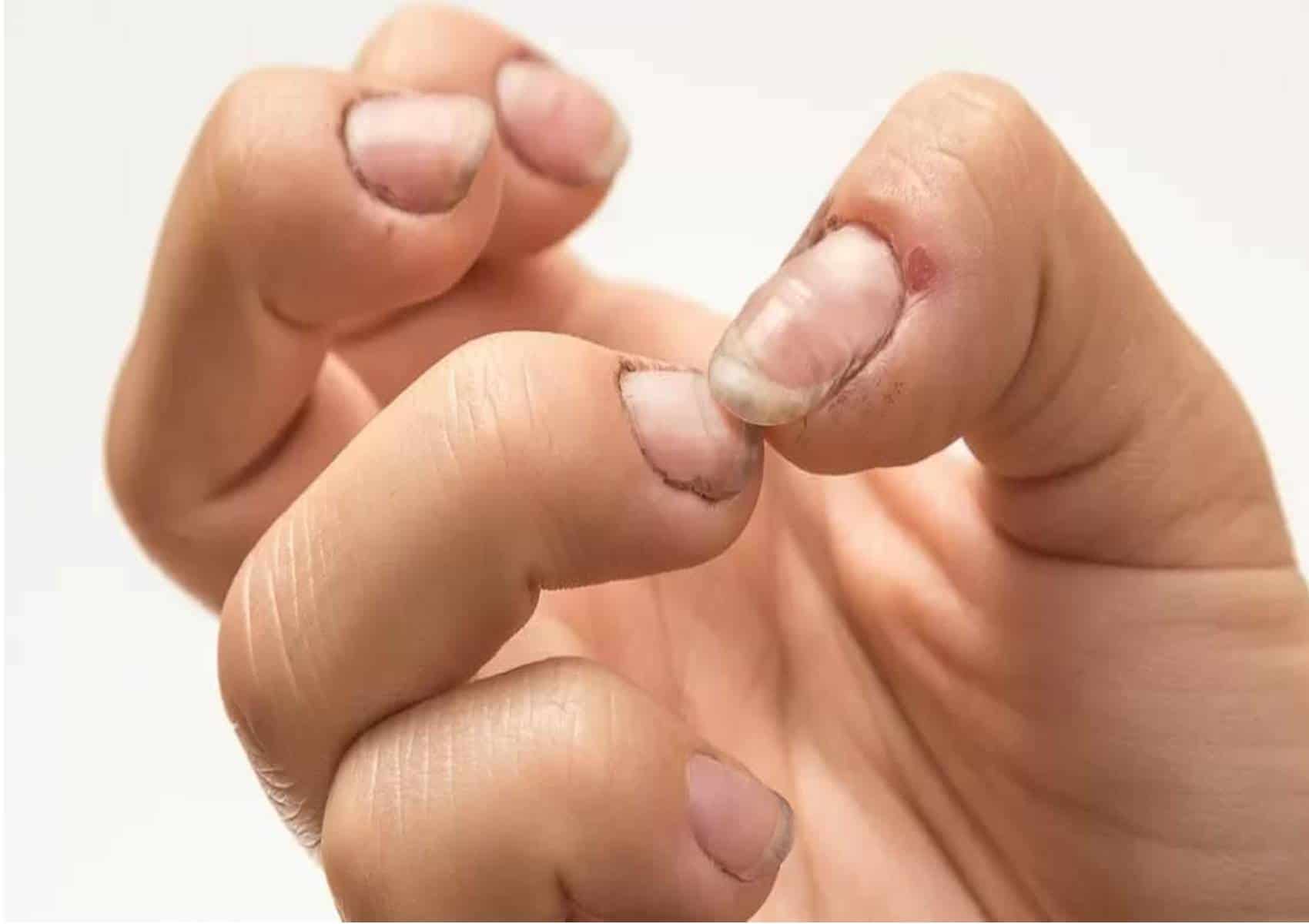 Prepare um fortalecedor para acabar com a descamação das unhas