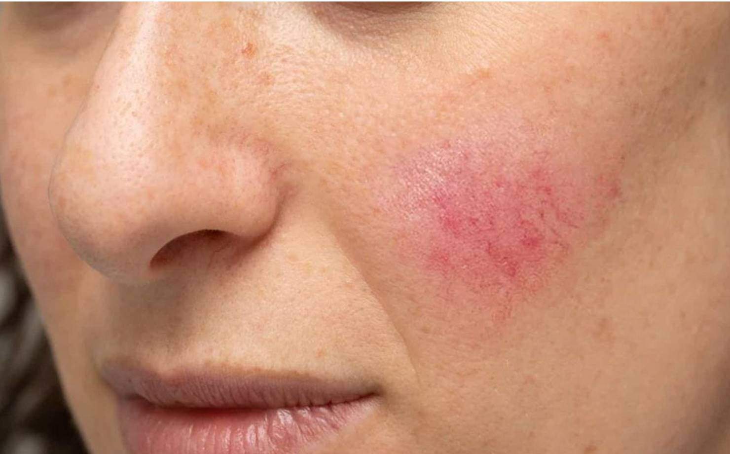 Mulher com Pele sensível apresentando mancha rosa no rosto