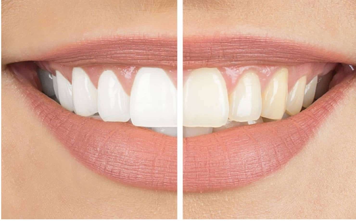Dentes Brancos