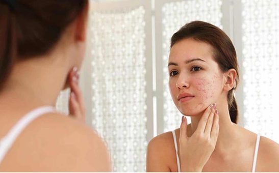 Conheça os melhores tratamentos para se livrar das cicatrizes de acne