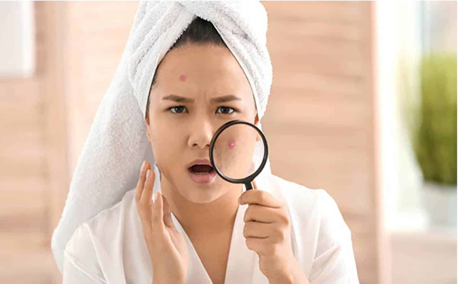 Aprenda alguns remédios caseiros para tratar acne menstrual