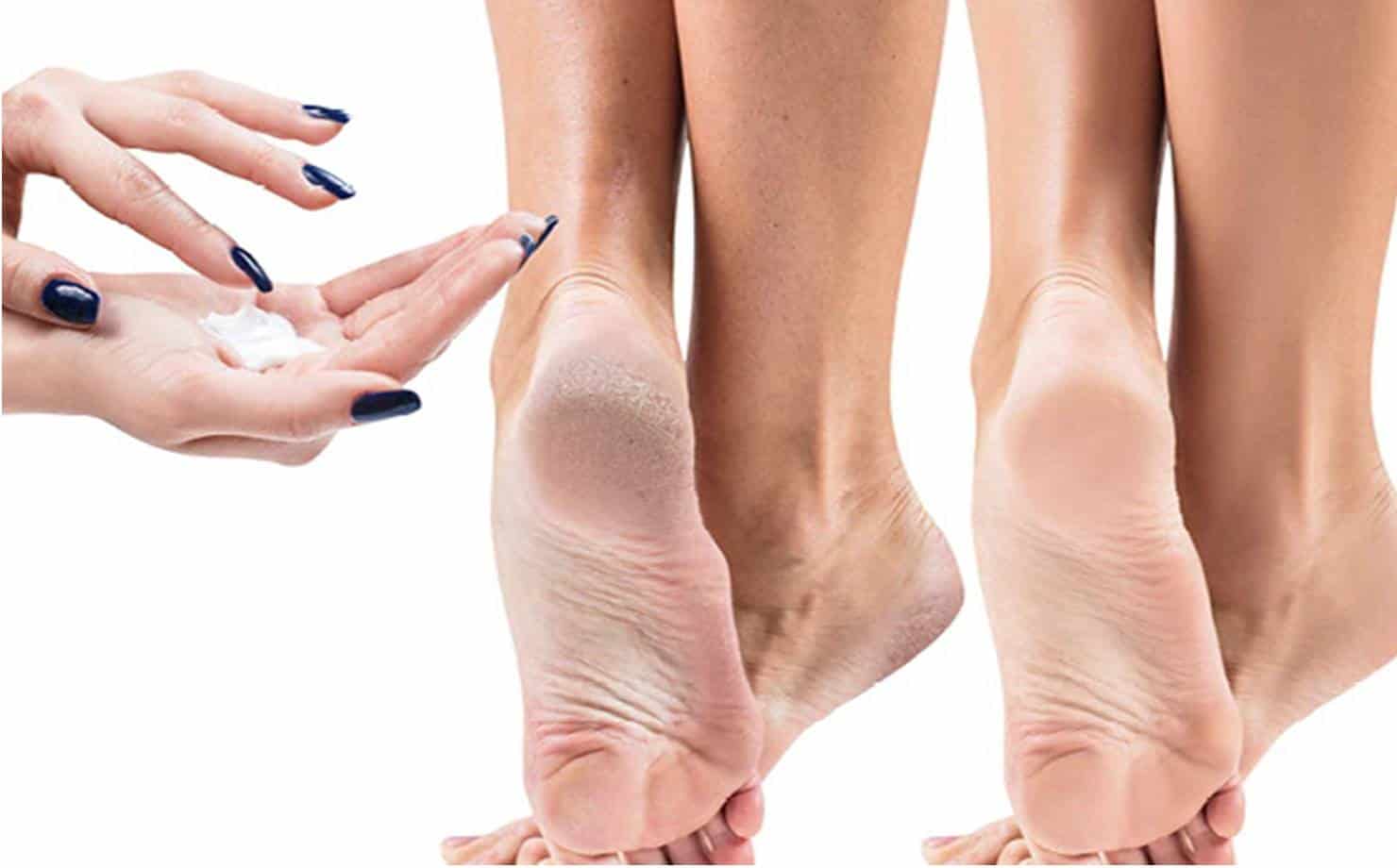 vaselina para tratar pés secos