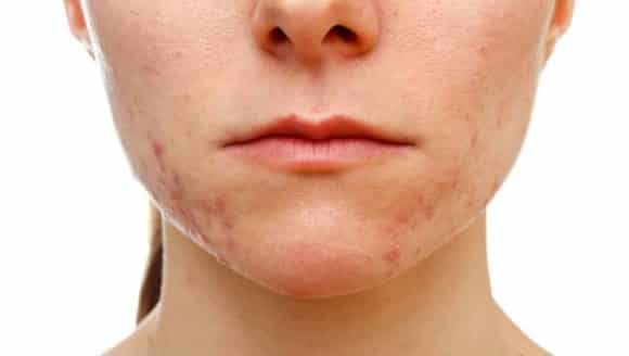 Manchas pós-acne: como evitar que elas apareçam no rosto?