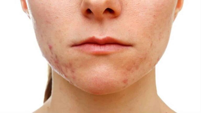 Estes ingredientes podem podem causar acne