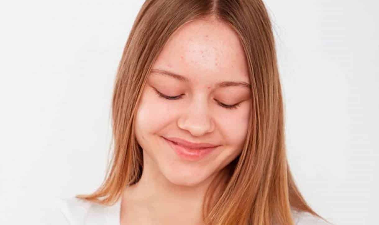 Dicas caseiras para eliminar as acnes causadas pelo ciclo menstrual