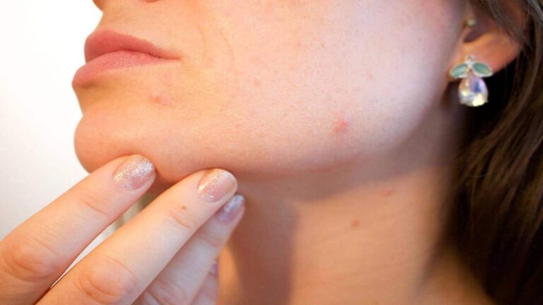 Livre-se da acne e obtenha uma pele de porcelana com essa dica