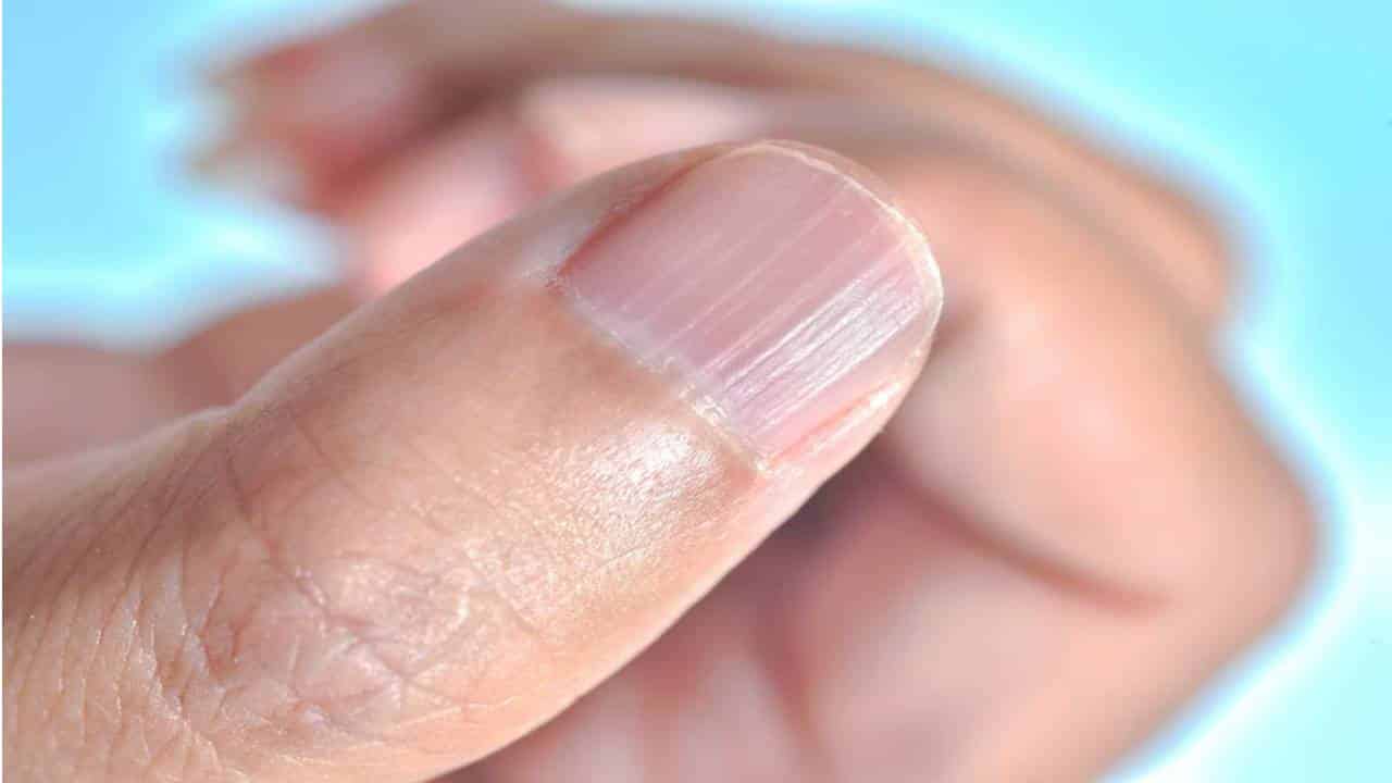 Estrias nas unhas: o que são e por que surgem?