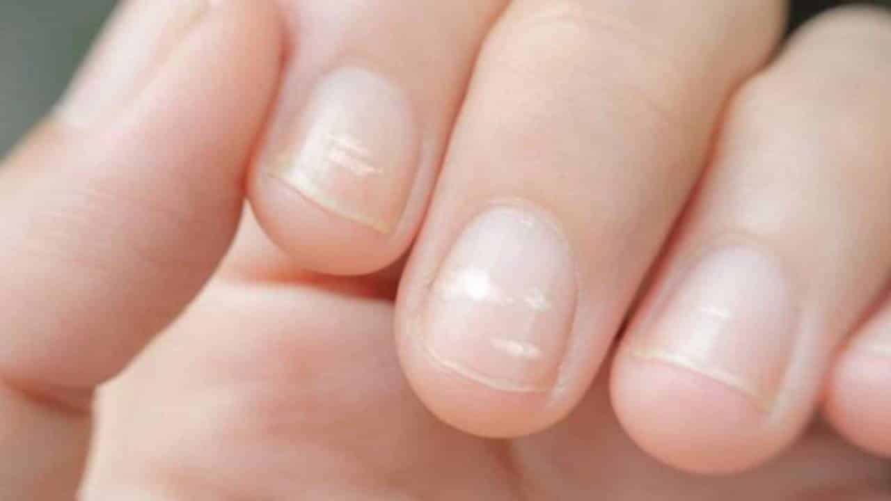 Por que manchas e linhas brancas aparecem nas unhas?