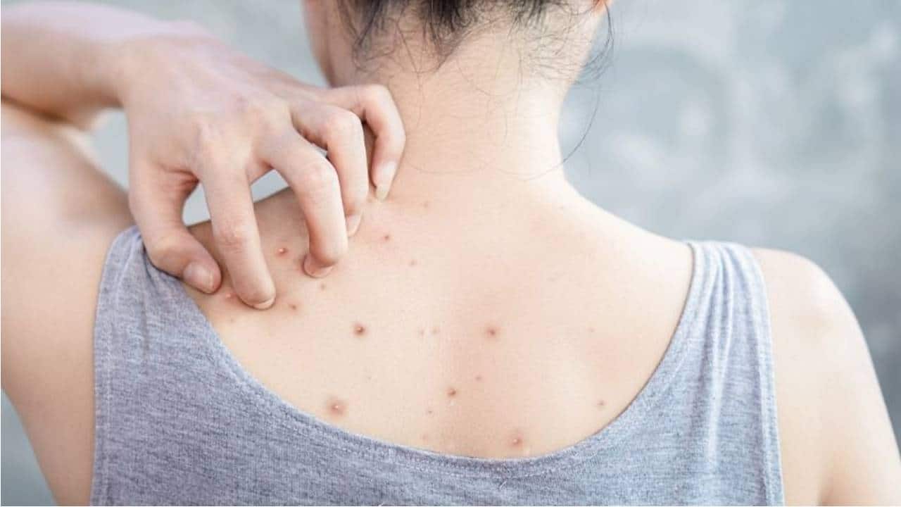 As melhores dicas para tratar acne nas costas