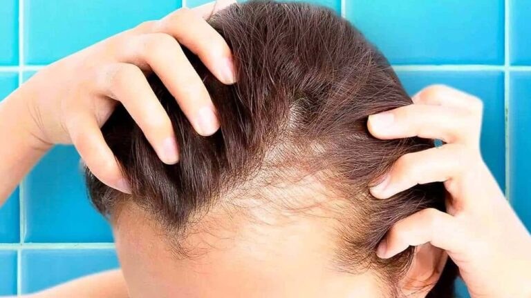 Máscara capilar para estimular o crescimento de cabelo nas áreas mais calvas