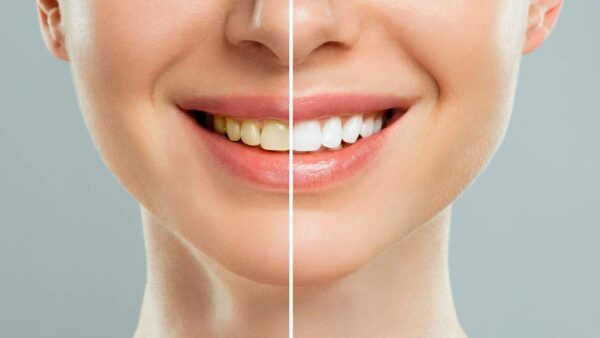 métodos naturais para clarear os dentes