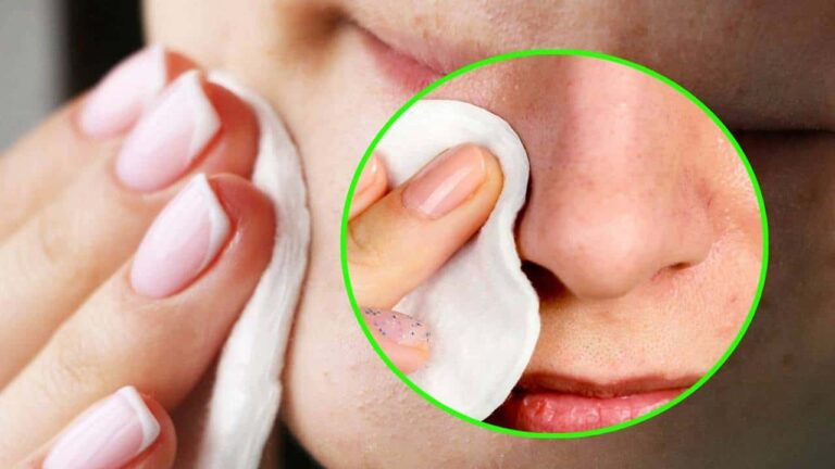Segredo para eliminar cravos de forma natural