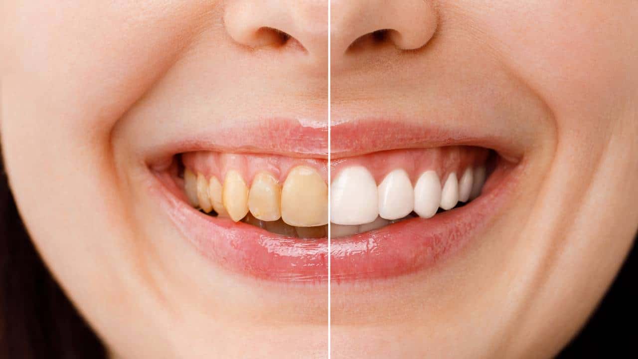 métodos naturais para clarear os dentes