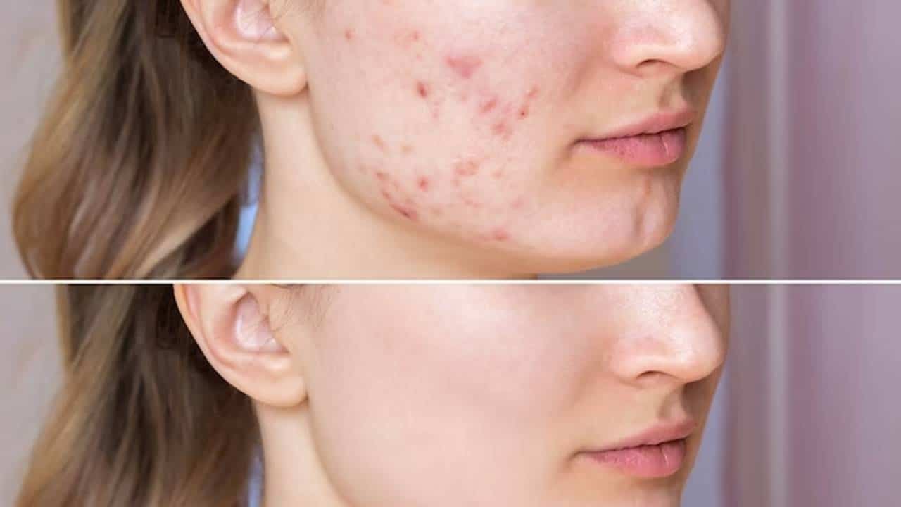 5 remédios caseiros para remover marcas de acne no rosto