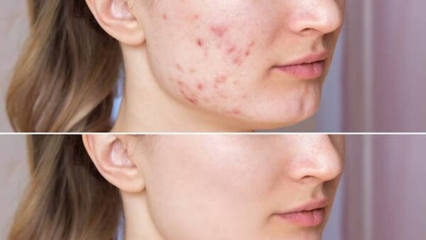 3 remédios naturais para reduzir as cicatrizes causadas pela acne