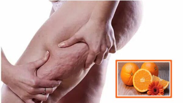 Tratamento caseiro de laranja para REDUZIR a celulite que você precisa experimentar