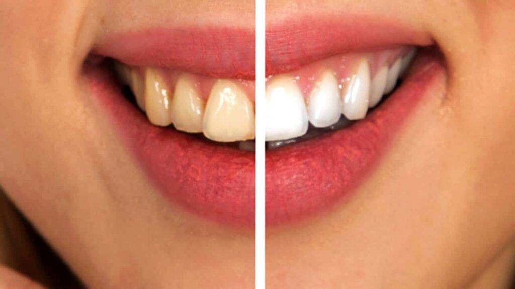 Quais alimentos podem manchar os dentes?