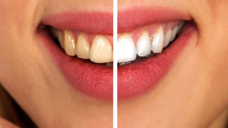 Quais alimentos podem manchar os dentes?