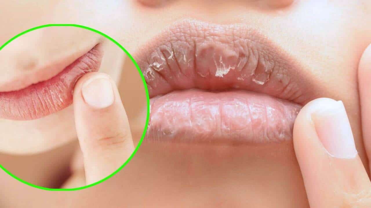 7 remédios naturais eficazes para lábios rachados: