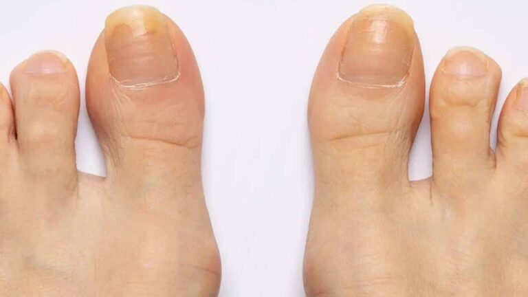 Como remover o amarelado das unhas dos pés?