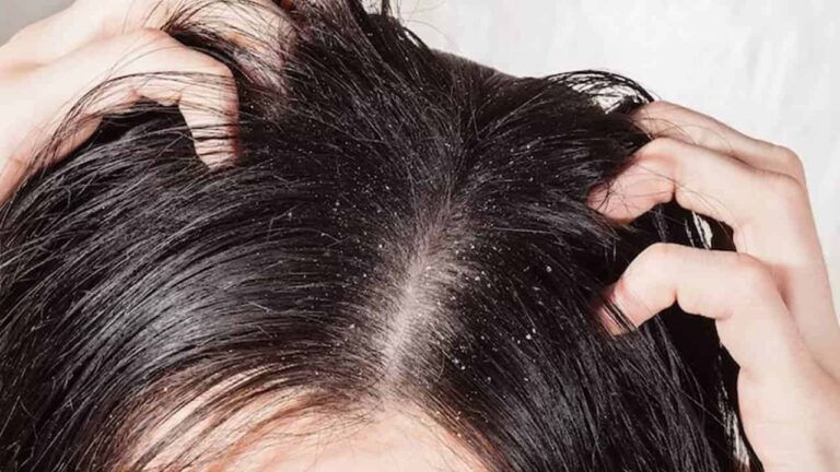 Elimine a caspa do seu cabelo com esta máscara esfoliante