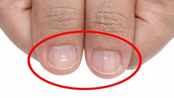 Se linhas brancas aparecerem nas suas unhas, esta é a vitamina que você é deficiente