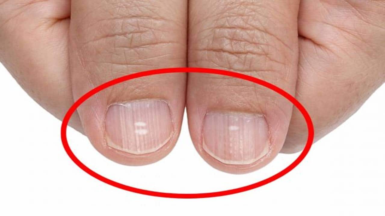 Se linhas brancas aparecerem nas suas unhas, esta é a vitamina que você é deficiente