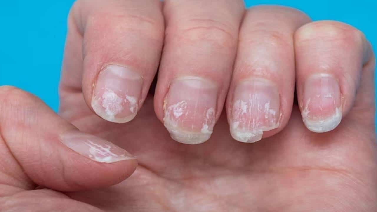 Como restaurar as unhas após remover o acrílico?