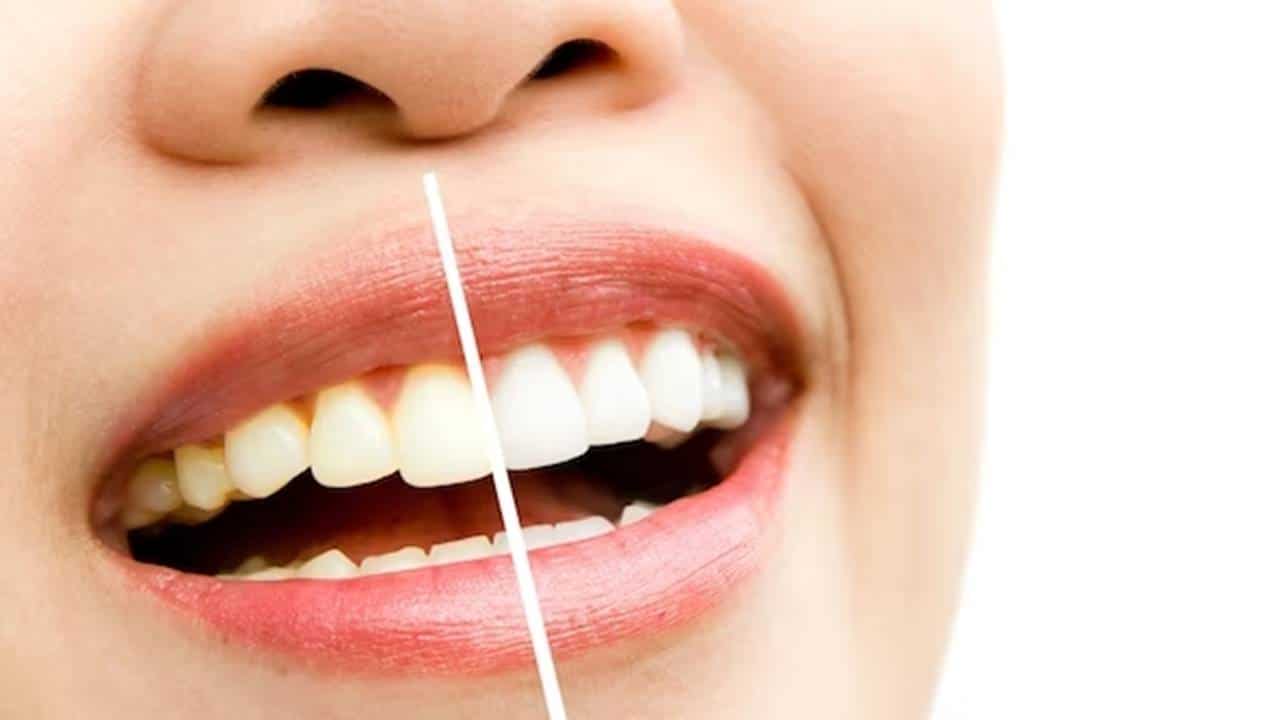 O melhor remédio caseiro para clarear os dentes sem danificá-los