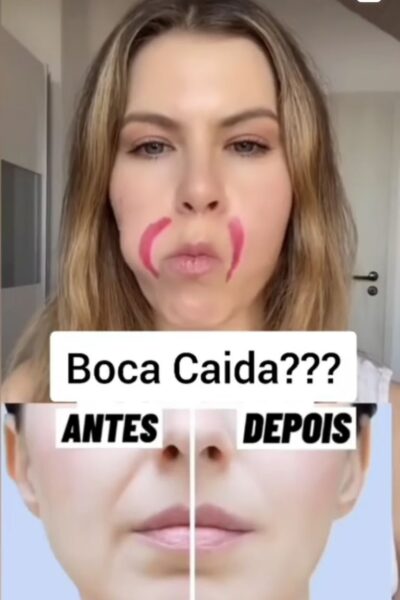 Como eliminar rugas e flacidez da boca