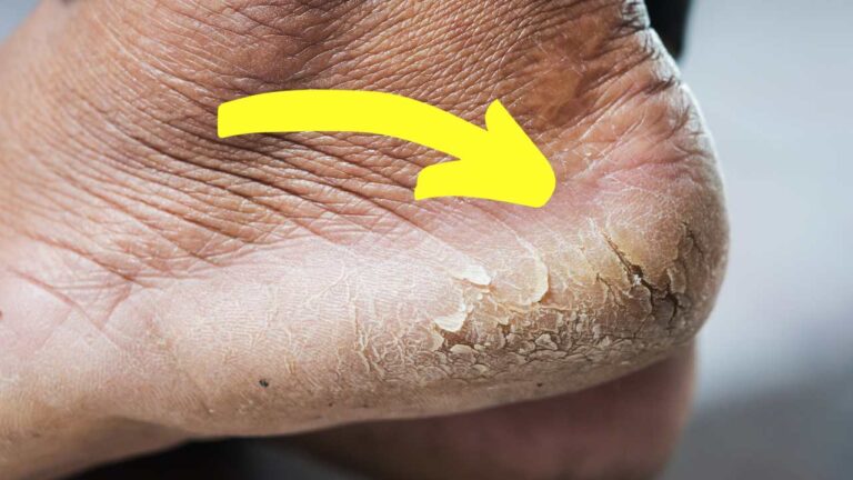 O remédio certo para remover calcanhares rachados e ter pés macios