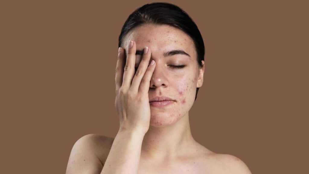 Como remover manchas e cicatrizes pós-acne no rosto