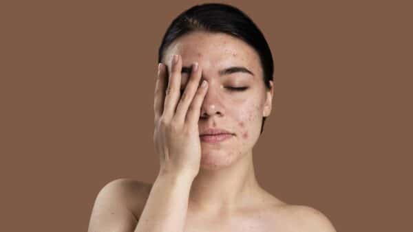 Hábitos diários podem PIORAR a acne