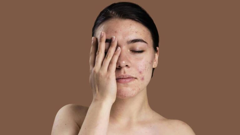 Como remover manchas e cicatrizes pós-acne no rosto