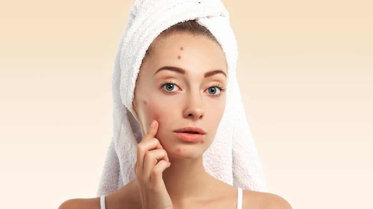 Hábito surpreendente que elimina a acne