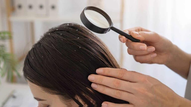 couro cabeludo saudável sem caspas cabelo