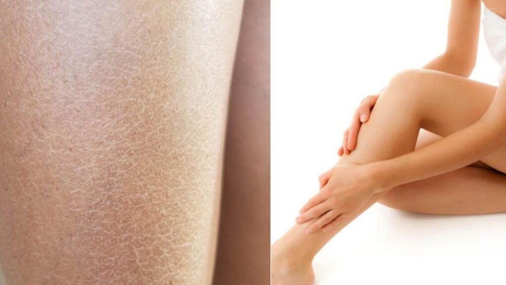 Pele Seca e Áspera? Resolva esse problema usando apenas um ingrediente