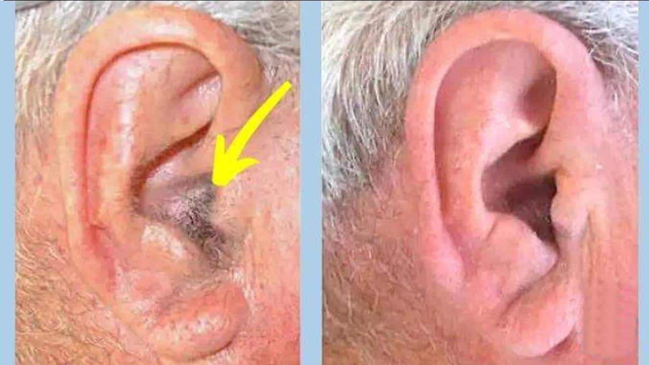 “Tenho pelos nas orelhas”: Veja 5 dicas que funcionam para erradicá-los