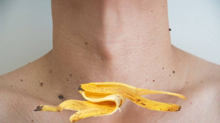 Casca de banana para verrugas