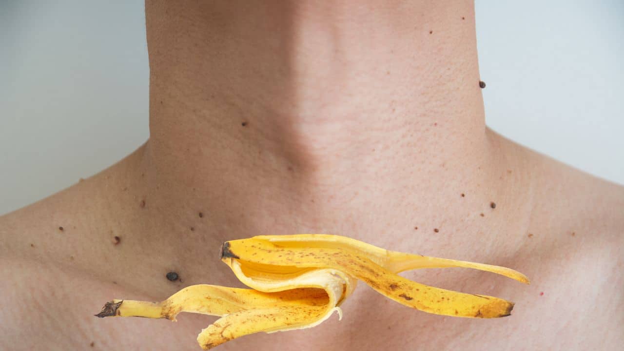 Casca de banana para verrugas: Um remédio caseiro para remover!