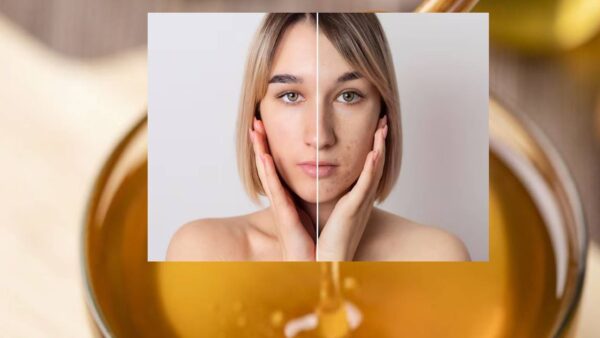 Como usar mel para remover marcas de acne