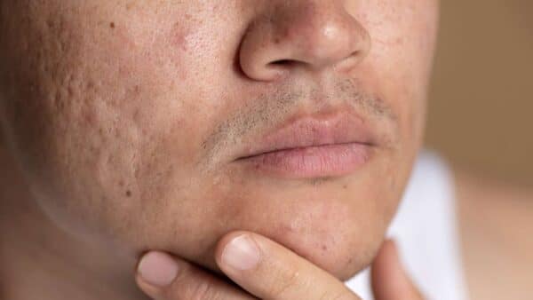 cicatrizes de acne na pele