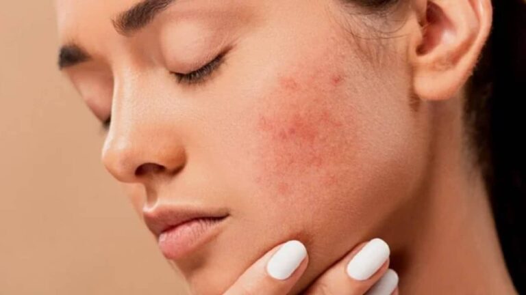 Descubra como ter uma pele sem acne