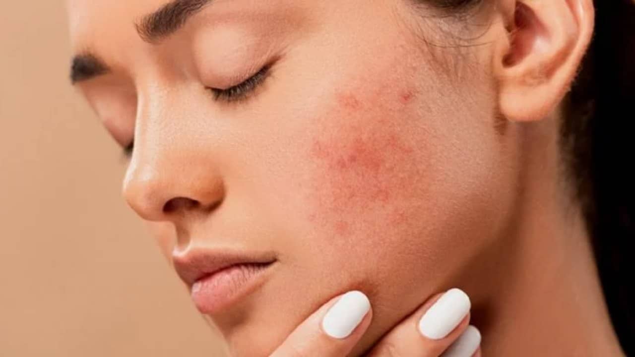 remover as acnes da sua pele