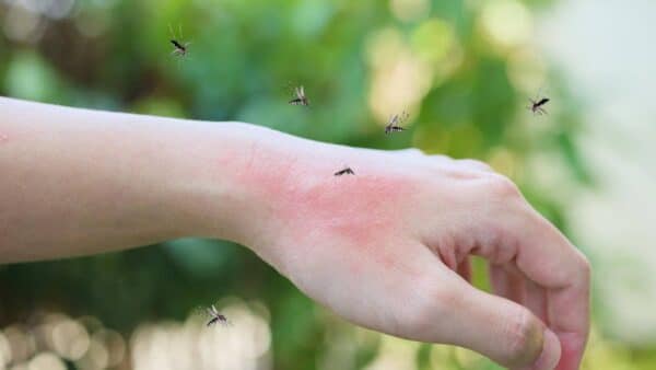 aliviar picadas de mosquito